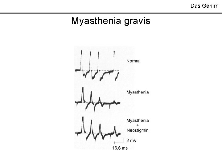 Das Gehirn Myasthenia gravis 