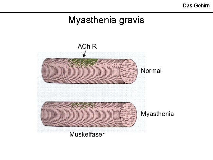 Das Gehirn Myasthenia gravis 