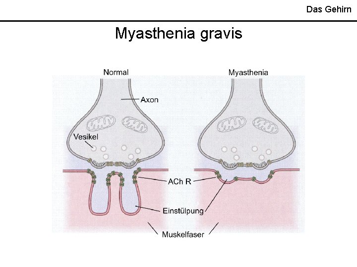 Das Gehirn Myasthenia gravis 