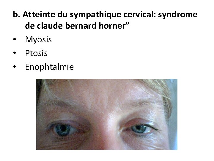 b. Atteinte du sympathique cervical: syndrome de claude bernard horner” • Myosis • Ptosis
