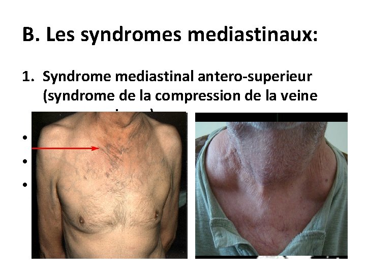 B. Les syndromes mediastinaux: 1. Syndrome mediastinal antero-superieur (syndrome de la compression de la