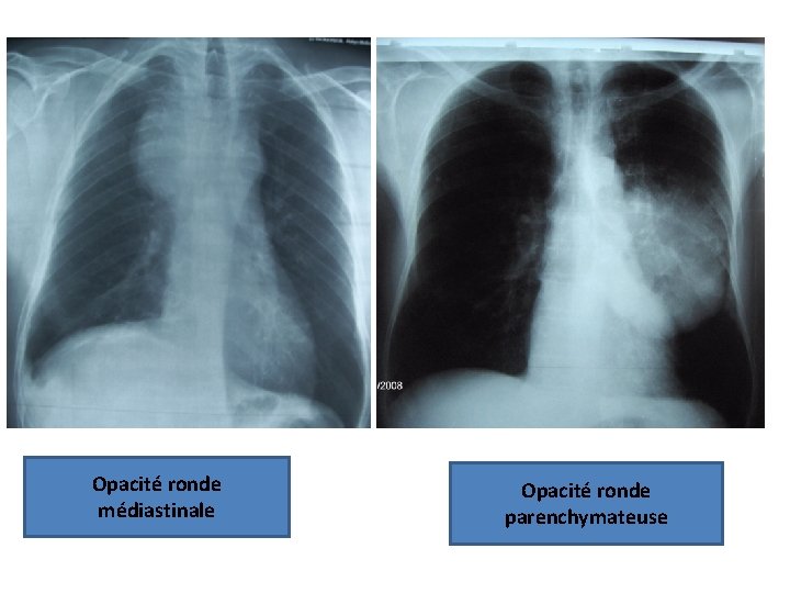 Opacité ronde médiastinale Opacité ronde parenchymateuse 