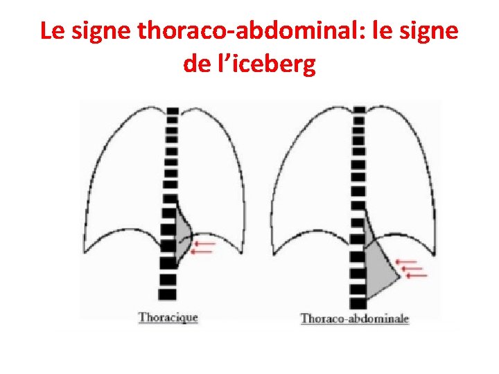 Le signe thoraco-abdominal: le signe de l’iceberg 