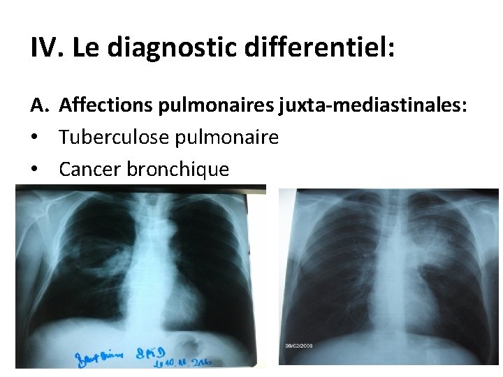 IV. Le diagnostic differentiel: A. Affections pulmonaires juxta-mediastinales: • Tuberculose pulmonaire • Cancer bronchique