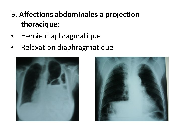 B. Affections abdominales a projection thoracique: • Hernie diaphragmatique • Relaxation diaphragmatique 