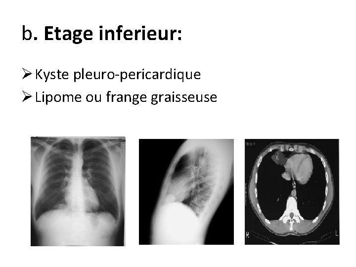 b. Etage inferieur: Ø Kyste pleuro-pericardique Ø Lipome ou frange graisseuse 