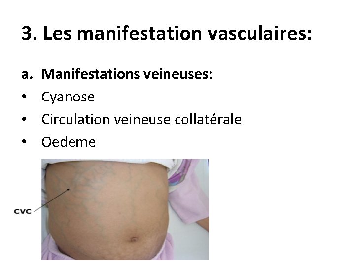 3. Les manifestation vasculaires: a. • • • Manifestations veineuses: Cyanose Circulation veineuse collatérale