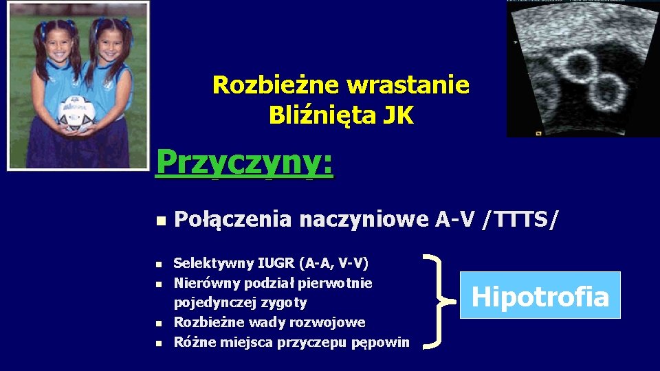 Rozbieżne wrastanie Bliźnięta JK Przyczyny: n n n Połączenia naczyniowe A-V /TTTS/ Selektywny IUGR
