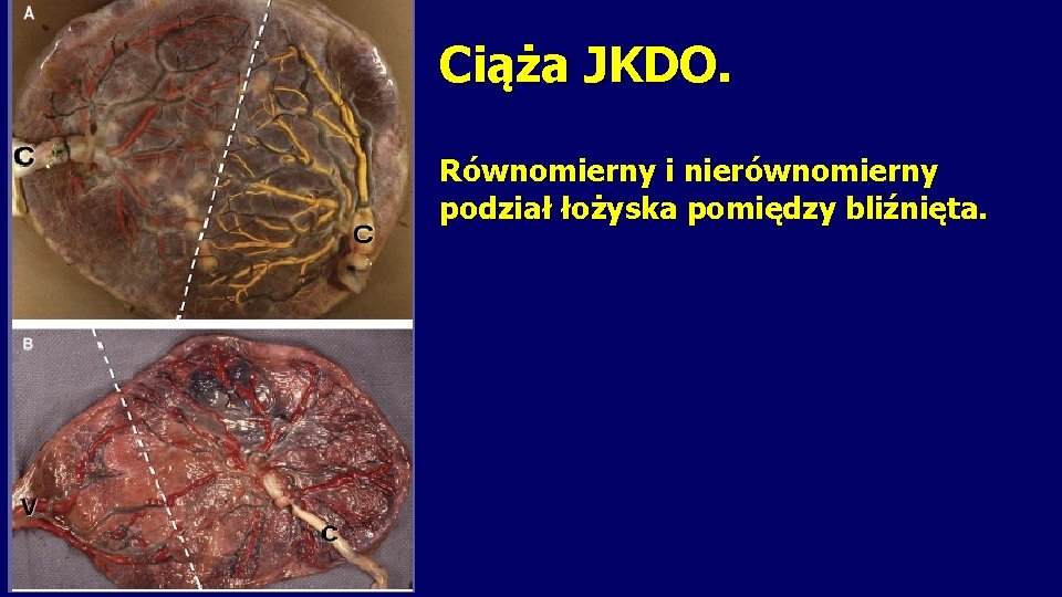 Ciąża JKDO. Równomierny i nierównomierny podział łożyska pomiędzy bliźnięta. 