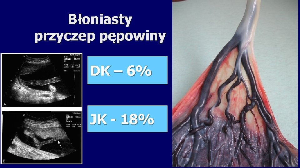 Błoniasty przyczep pępowiny DK – 6% JK - 18% 