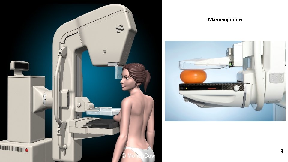 Mammography 3 
