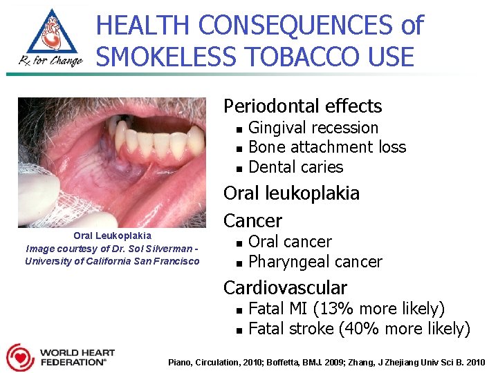 HEALTH CONSEQUENCES of SMOKELESS TOBACCO USE Periodontal effects n n n Oral Leukoplakia Image