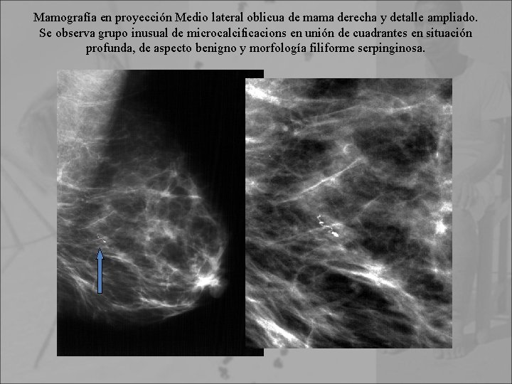 Mamografía en proyección Medio lateral oblicua de mama derecha y detalle ampliado. Se observa