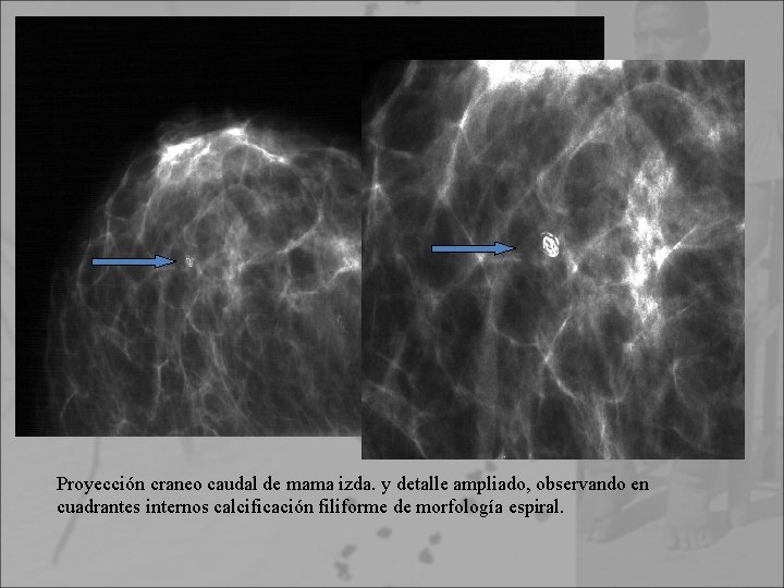 Proyección craneo caudal de mama izda. y detalle ampliado, observando en cuadrantes internos calcificación