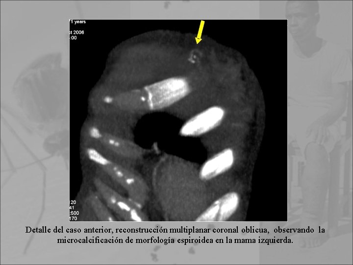 Detalle del caso anterior, reconstrucción multiplanar coronal oblicua, observando la microcalcificación de morfología espiroidea