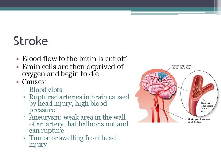 Stroke • Blood flow to the brain is cut off • Brain cells are