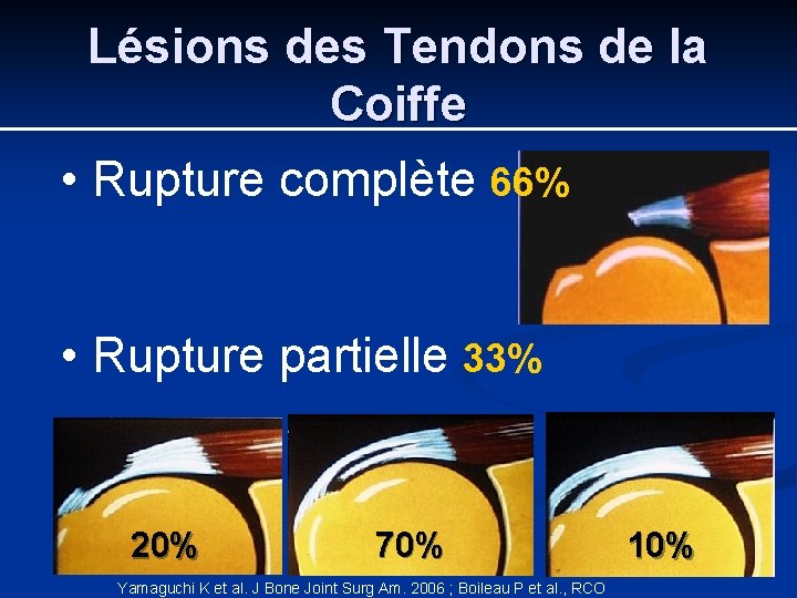 Lésions des Tendons de la Coiffe • Rupture complète 66% • Rupture partielle 33%