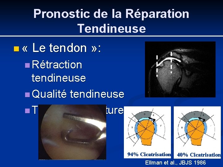 Pronostic de la Réparation Tendineuse n « Le tendon » : n Rétraction tendineuse