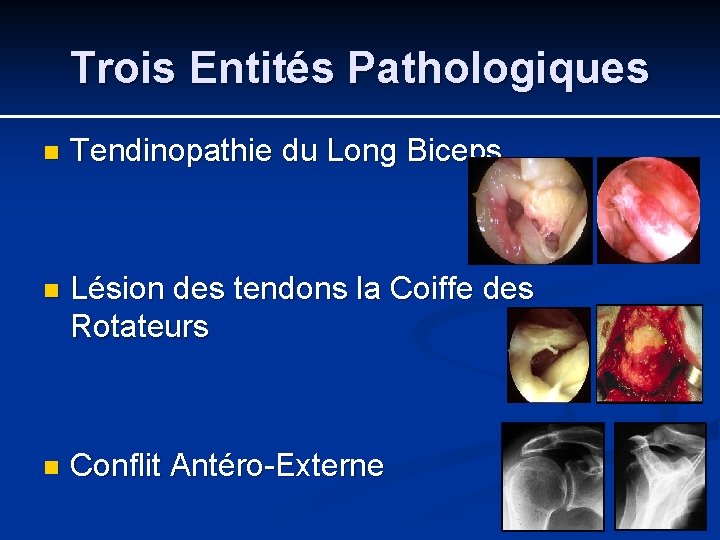 Trois Entités Pathologiques n Tendinopathie du Long Biceps n Lésion des tendons la Coiffe