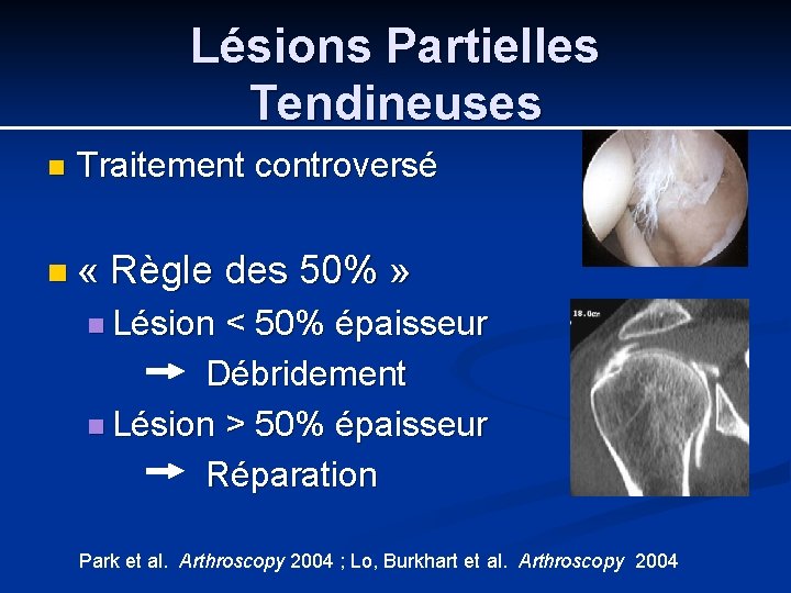 Lésions Partielles Tendineuses n Traitement controversé n « Règle des 50% » n Lésion