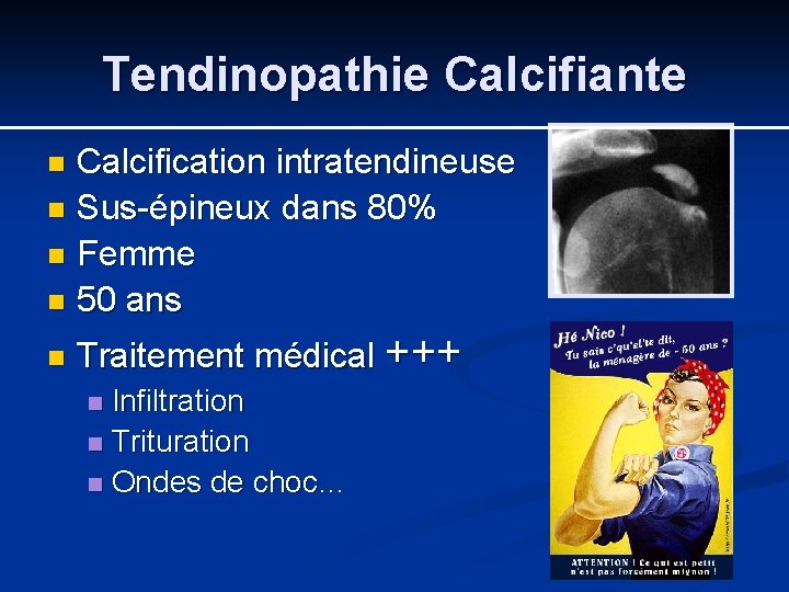 Tendinopathie Calcifiante Calcification intratendineuse n Sus-épineux dans 80% n Femme n 50 ans n
