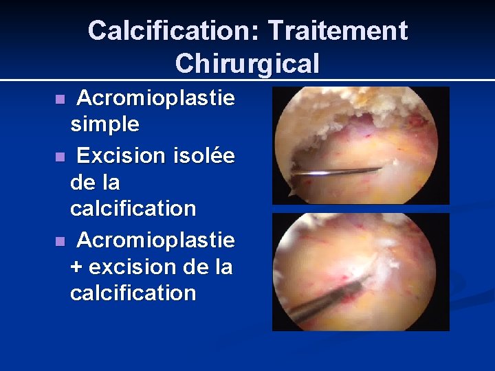 Calcification: Traitement Chirurgical Acromioplastie simple n Excision isolée de la calcification n Acromioplastie +