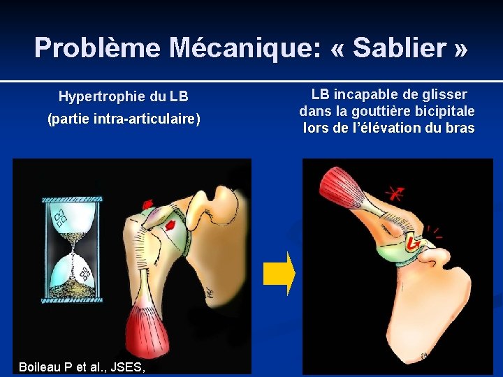 Problème Mécanique: « Sablier » Hypertrophie du LB (partie intra-articulaire) Boileau P et al.