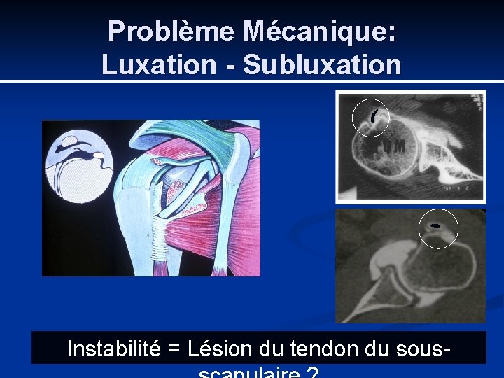Problème Mécanique: Luxation - Subluxation Instabilité = Lésion du tendon du sous- 