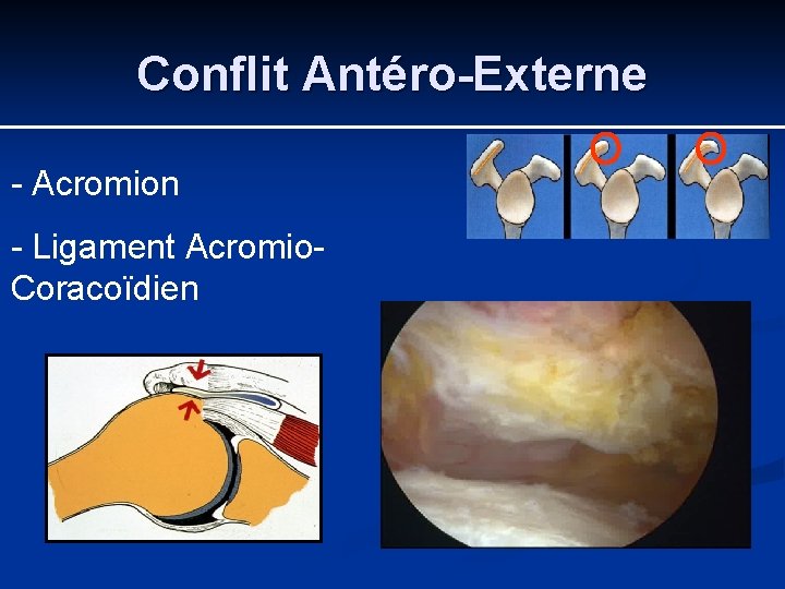 Conflit Antéro-Externe - Acromion - Ligament Acromio. Coracoïdien 