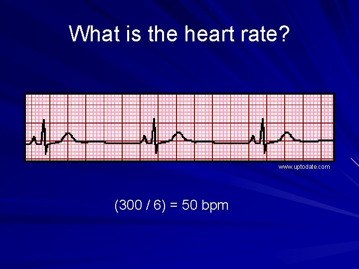 What is the heart rate? www. uptodate. com (300 / 6) = 50 bpm
