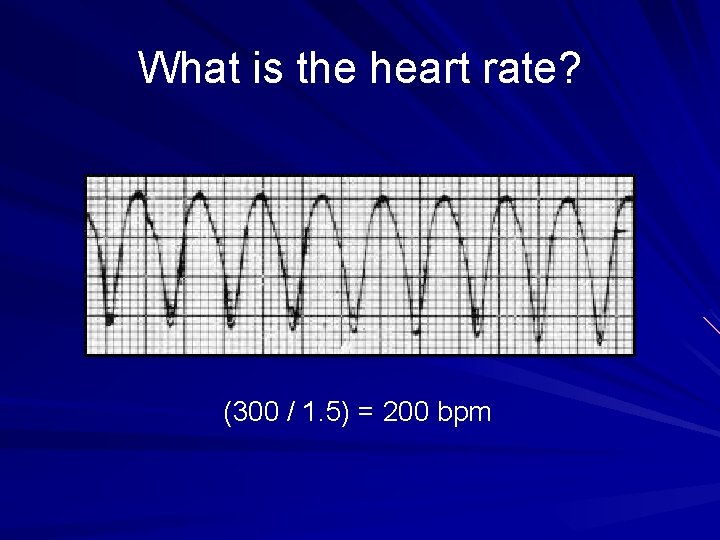 What is the heart rate? (300 / 1. 5) = 200 bpm 