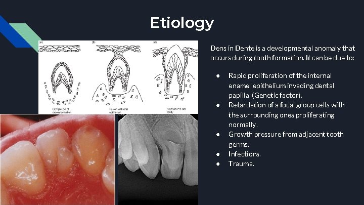 Etiology Dens in Dente is a developmental anomaly that occurs during tooth formation. It