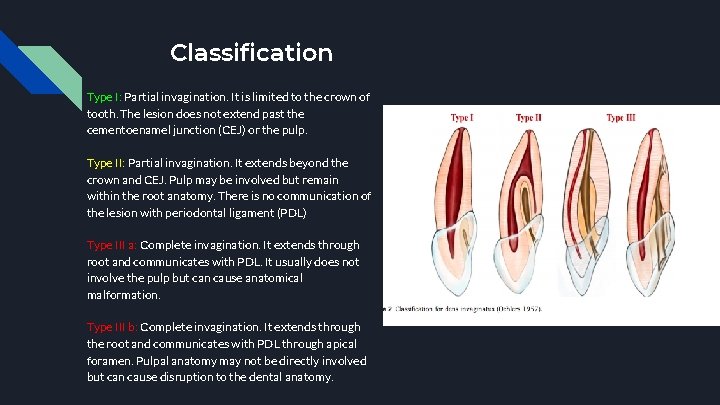Classification Type I: Partial invagination. It is limited to the crown of tooth. The