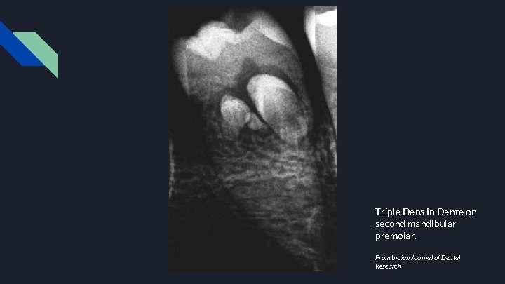 Triple Dens In Dente on second mandibular premolar. From Indian Journal of Dental Research