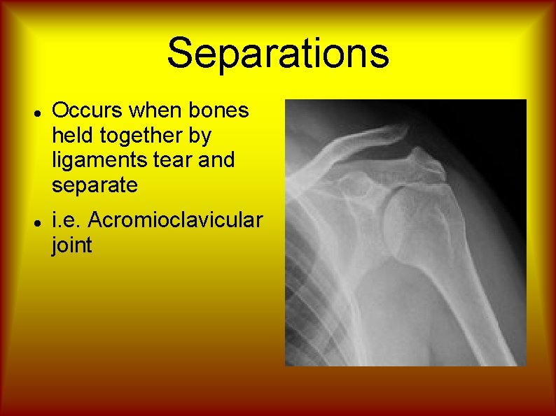 Separations Occurs when bones held together by ligaments tear and separate i. e. Acromioclavicular
