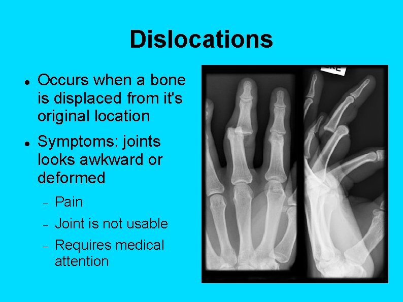 Dislocations Occurs when a bone is displaced from it's original location Symptoms: joints looks