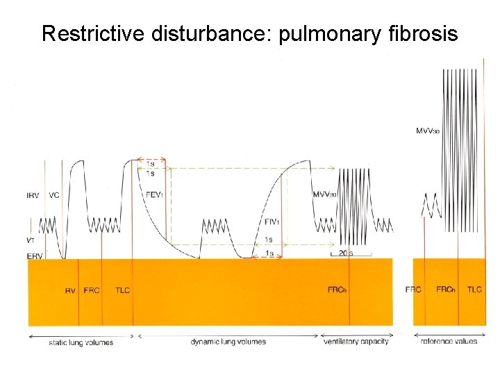 Restrictive disturbance: pulmonary fibrosis 