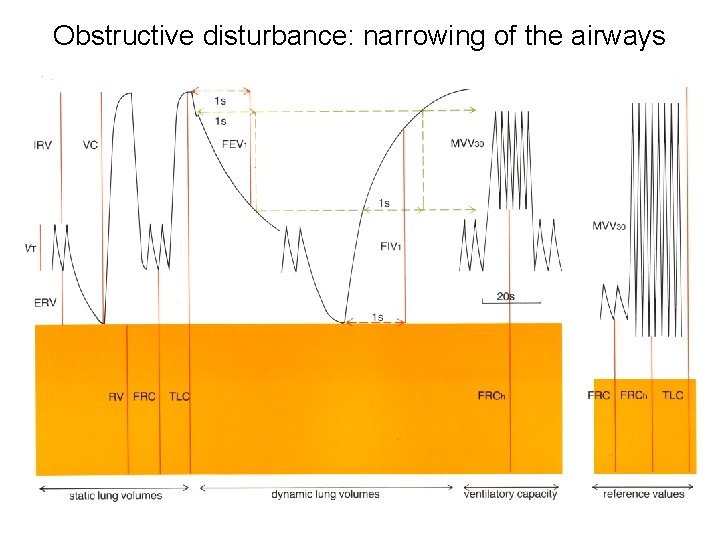 Obstructive disturbance: narrowing of the airways 