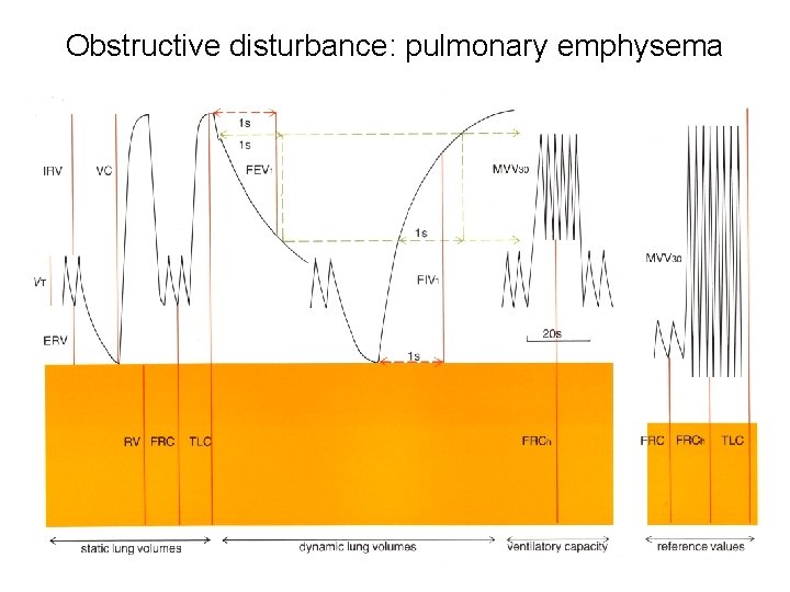 Obstructive disturbance: pulmonary emphysema 