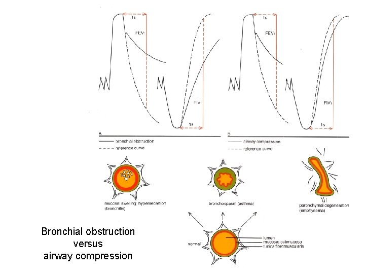 Bronchial obstruction versus airway compression 