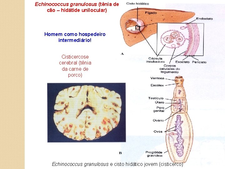 Echinococcus granulosus (tênia de cão – hidátide unilocular) Homem como hospedeiro intermediário! Cisticercose cerebral