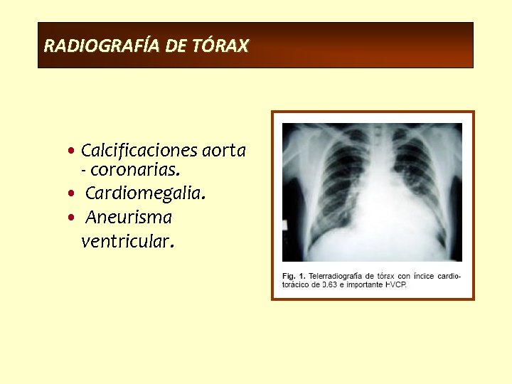 RADIOGRAFÍA DE TÓRAX • Calcificaciones aorta - coronarias. • Cardiomegalia. • Aneurisma ventricular. 