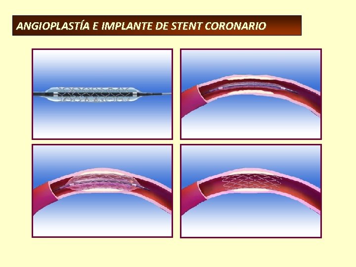 ANGIOPLASTÍA E IMPLANTE DE STENT CORONARIO 