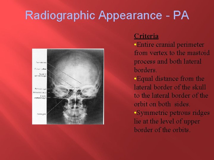 Radiographic Appearance - PA Criteria • Entire cranial perimeter from vertex to the mastoid