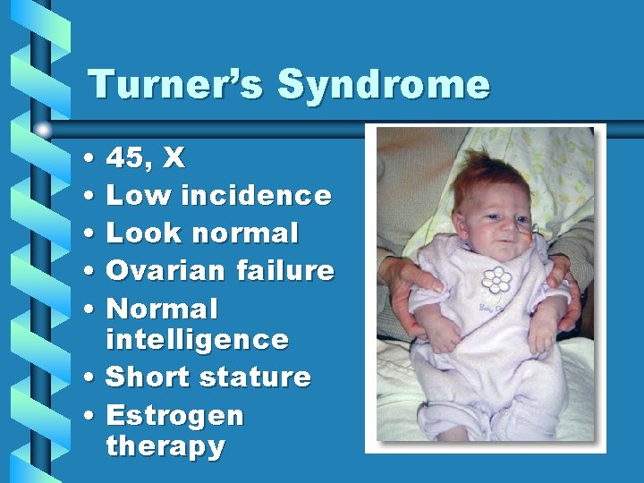 Turner’s Syndrome • 45, X • Low incidence • Look normal • Ovarian failure