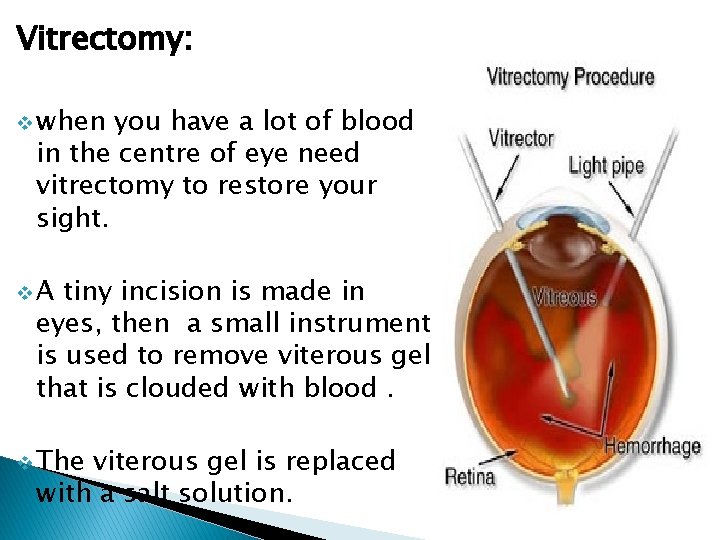 Vitrectomy: v when you have a lot of blood in the centre of eye
