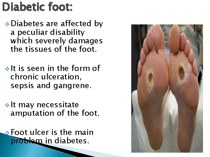 Diabetic foot: v Diabetes are affected by a peculiar disability which severely damages the