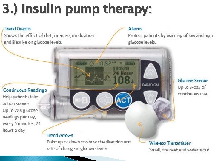 3. ) Insulin pump therapy: 