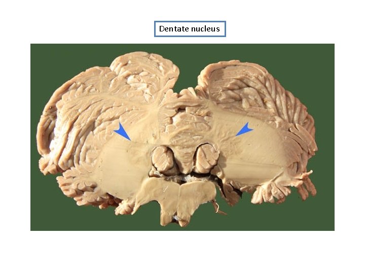 Dentate nucleus 