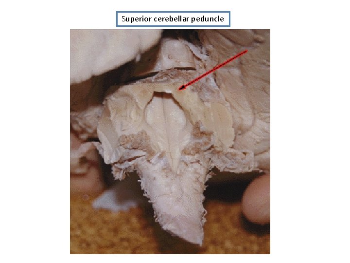 Superior cerebellar peduncle 